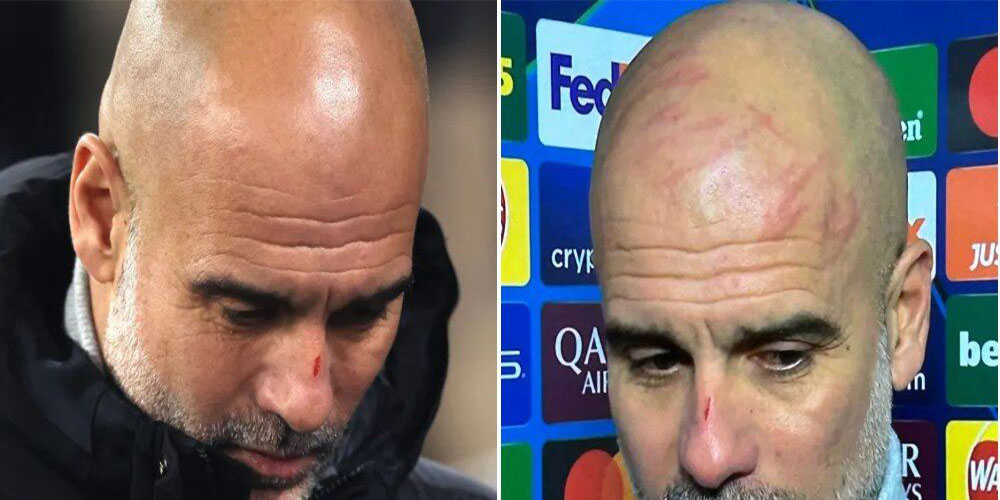 گواردیولا: خودم با ناخنم صورتم را زخمی کردم! 