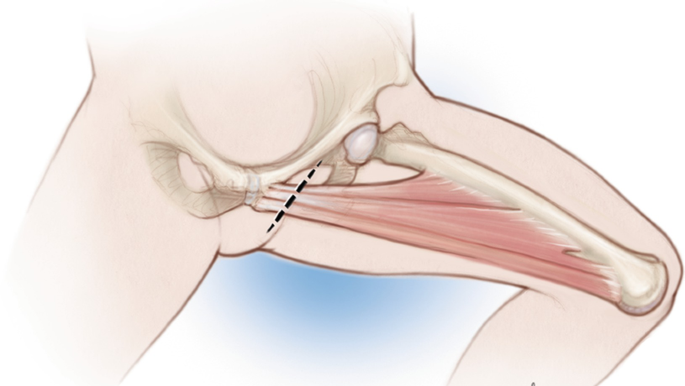 تشخیص پوبالژیا