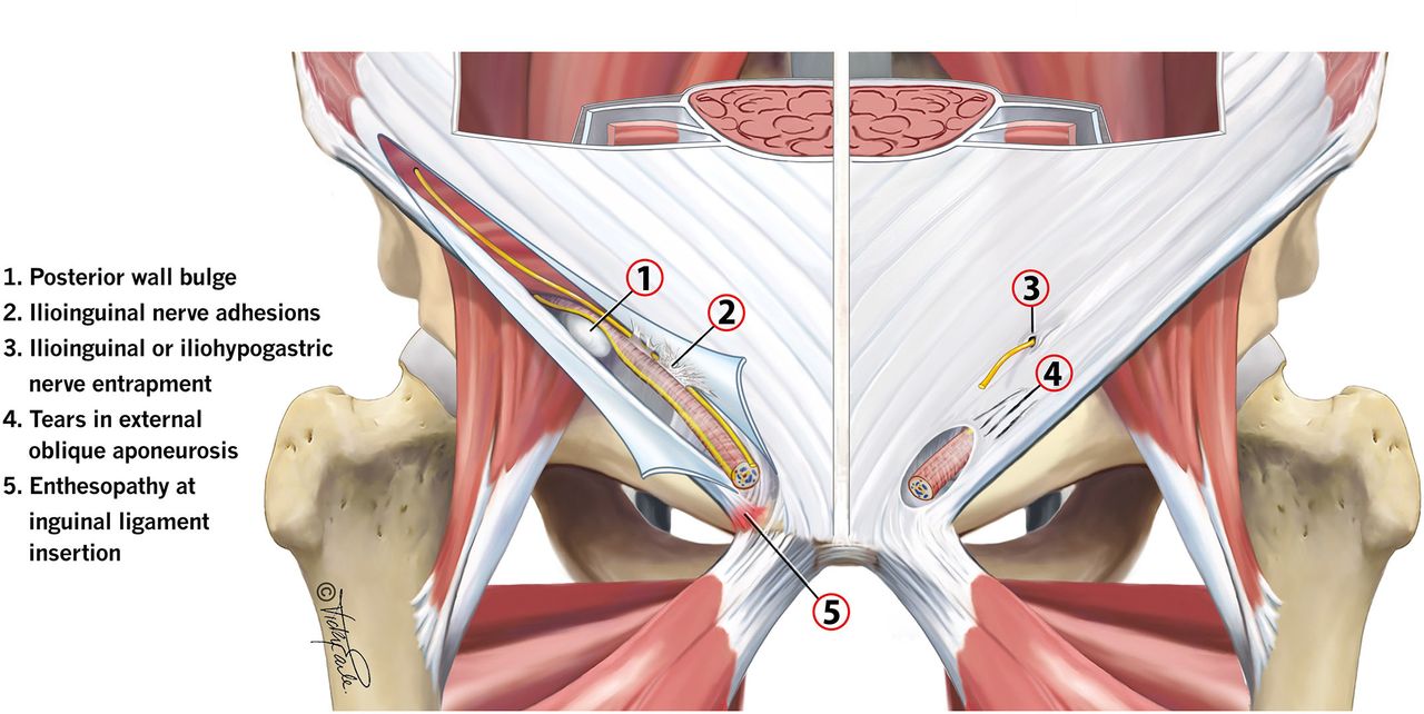 پوبالژیای اداکتور