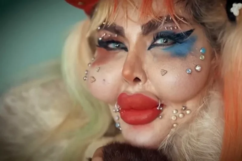 رکورد جهانی آناهیتا ناچو در جراحی زیبایی