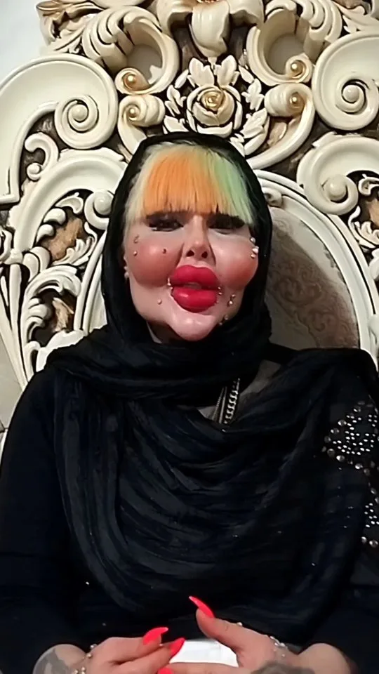 آناهیتا ناچو رکوردار گینس عمل زیبایی