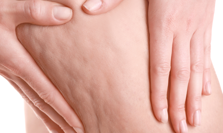 سلولیت نرم و طبیعی ترند 2026